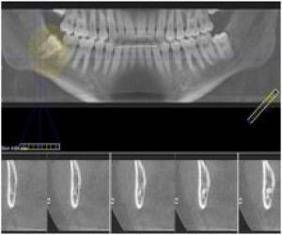 Les radiographies des dents augmenteraient elles le risque de tumeurs du cerveau ?