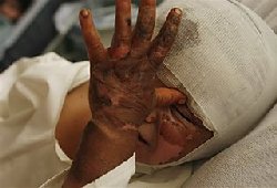 White Phosphorus? Concern over burns on Afghans caught in battle